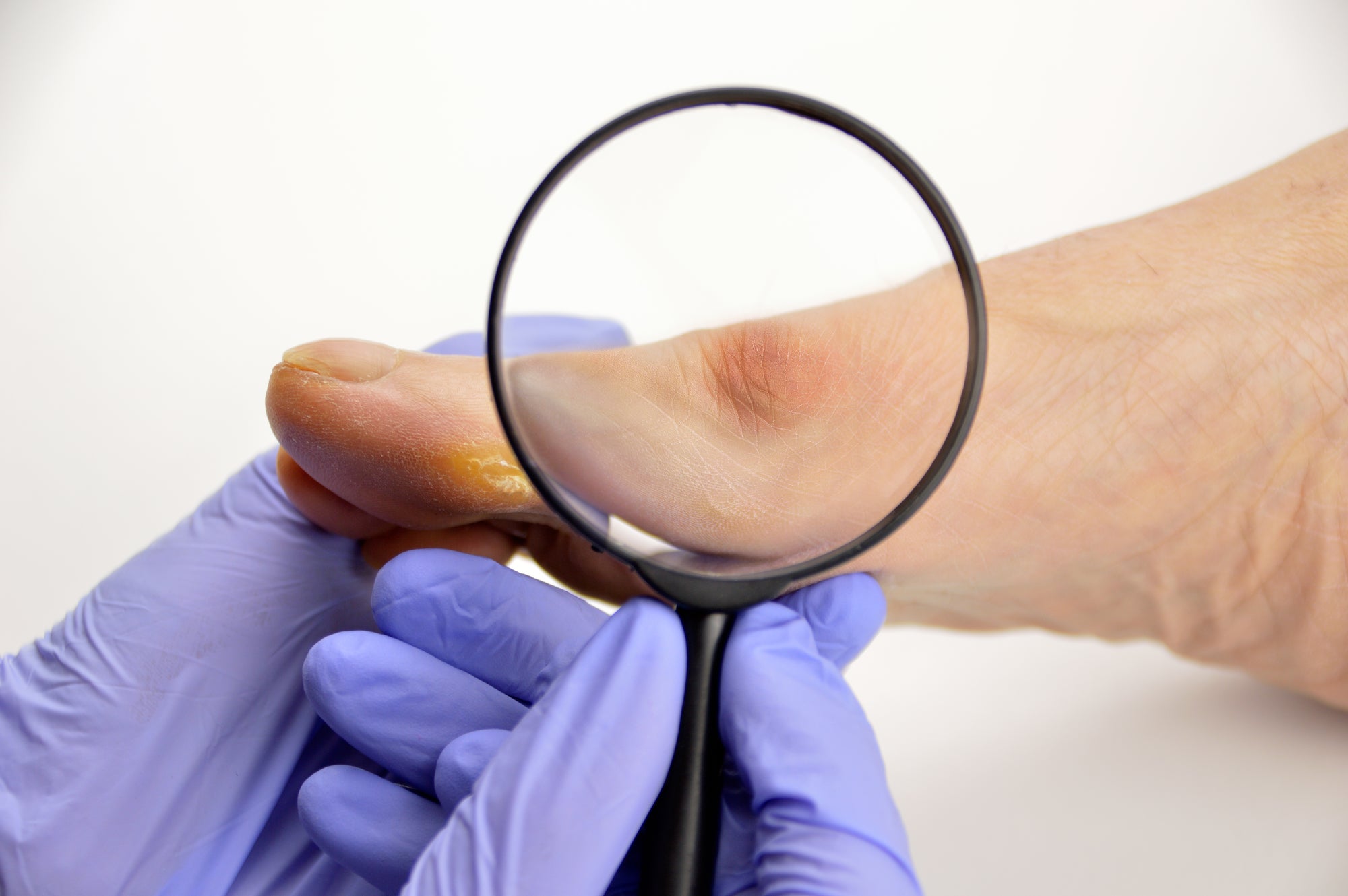 Bunions Part 2 -  Relief and Treatment