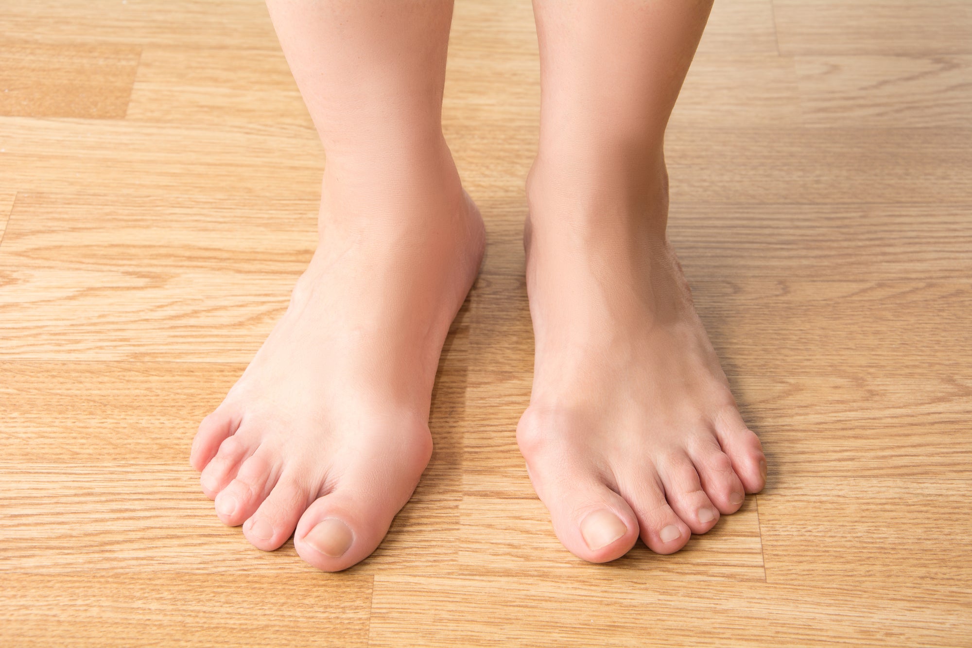Bunions Part 1 - Causes and Effects – Lemon Hero Health