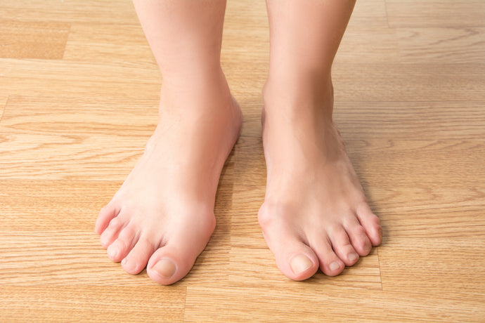 Bunions Part 1 - Causes and Effects